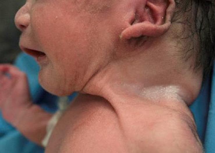 This clinical photograph shows a side profile of a neonate, highlighting characteristic dysmorphic features of the head and neck. The most prominent finding is a short, webbed neck (pterygium colli), with a redundant fold of skin extending from the mastoid area down to the acromion of the shoulder. The infant's ear is posteriorly rotated and positioned low relative to the facial features, with a small preauricular skin tag or appendage visible near the superior helix. The skin on the face and neck appears erythematous and exhibits fine desquamation, typical of a newborn or preterm infant. Additionally, the posterior skull appears slightly flattened, and the neck region shows increased subcutaneous tissue or skin laxity. These visual signs are clinically significant in the evaluation of genetic syndromes, most notably Turner syndrome or Noonan syndrome, where webbed neck and ear malformations are hallmark physical findings.