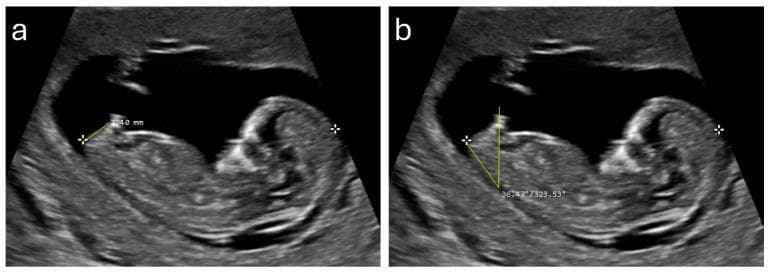 Diagnostic ultrasound images showing two side-by-side midsagittal views (a and b) of a fetus at approximately 12 weeks of gestation. The fetus is positioned in a supine orientation within the amniotic sac, with visible anatomical landmarks including the head, spine, and caudal region. The images demonstrate specific sonographic markers used for fetal sex determination. Panel (a) illustrates the measurement of the anogenital distance (AGD), shown as a linear caliper measurement (7.40 mm) extending from the anterior edge of the anus to the tip of the genital tubercle. Panel (b) illustrates the genital tubercle angle (GTA), showing an angular measurement (36.47 degrees) formed between a horizontal reference line and the longitudinal axis of the genital tubercle. These sonographic markers are clinically relevant for early prenatal screening and gender identification, as larger AGD and higher GTA values are statistically associated with male fetal development during the first trimester.
