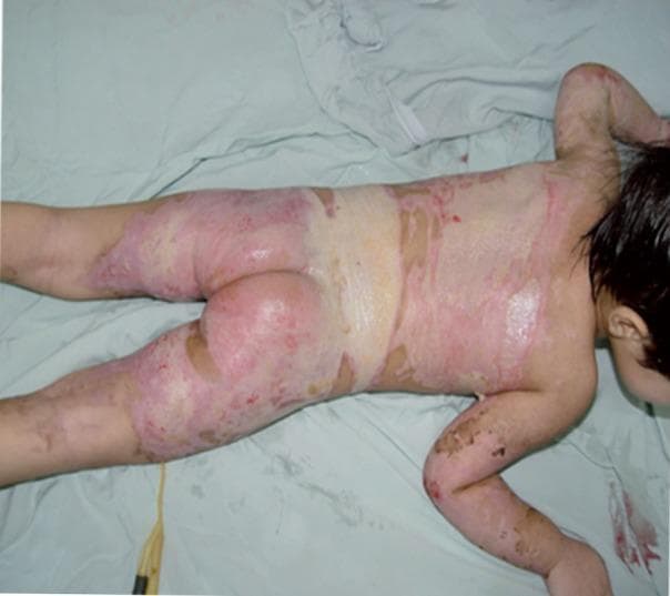 Clinical photograph of a pediatric patient in prone position demonstrating extensive partial-thickness and full-thickness burns across the posterior trunk, buttocks, and lower extremities. The burn wounds exhibit mixed characteristics: erythematous and weeping areas suggestive of superficial partial-thickness (second-degree) injury, interspersed with pale, whitish, and yellowish leathery patches indicative of deep partial-thickness or full-thickness (third-degree) tissue damage. Significant skin desquamation and raw dermal exposure are visible, particularly on the back and proximal thighs. The distribution is patchy but widespread, involving a substantial percentage of the total body surface area (TBSA). The presence of a moist appearance suggests the application of topical antimicrobial agents or wound exudate. This image serves as a clinical example of severe thermal trauma in a child, highlighting the necessity for intensive burn management, including fluid resuscitation, wound debridement, and potential surgical intervention.