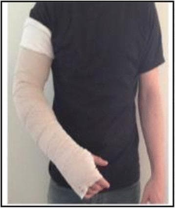 This clinical photograph demonstrates the application of multi-layer compression bandaging (CB) on the right upper extremity of an individual. The bandage system is applied over a protective white tubular sleeve or stockinette used to protect the skin and distal joints. The compression wrap is composed of non-elastic, short-stretch bandage material applied in a spiral or herringbone pattern to provide high working pressure and low resting pressure. The coverage extends from the metacarpophalangeal joints of the hand, through the wrist and forearm, and up to the mid-humerus, just below the deltoid insertion. The fingers and thumb are left exposed to monitor neurovascular status and allow for functional movement. This type of compression intervention is a core component of Complete Decongestive Therapy (CDT) for the management of breast cancer-related lymphedema or chronic edema. The image illustrates the specific technique for night-time self-management or clinician-assisted bandaging to maintain limb volume reduction.