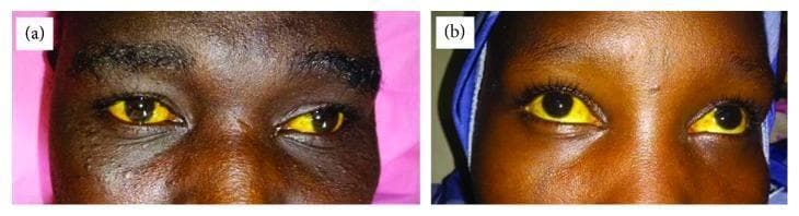 This clinical photograph consists of two panels, (a) and (b), displaying a close-up view of the eyes of two different patients. Both images demonstrate significant conjunctival icterus (scleral jaundice), characterized by a deep, uniform yellow discoloration of the sclera in both eyes. The intensity of the pigmentation is marked, standing in stark contrast to the dark irises. Aside from the jaundice, there are no visible signs of conjunctival injection, chemosis, or discharge. This finding is a clinical hallmark of hyperbilirubinemia, which in these cases is contextually associated with blackwater fever, a severe complication of Plasmodium falciparum malaria characterized by intravascular hemolysis. The visual documentation serves as an educational tool for recognizing advanced jaundice in patients with dark skin tones, where mucosal and scleral examination is critical for detecting hyperbilirubinemia.