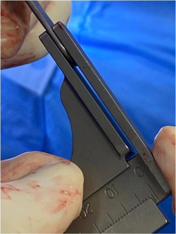 This intraoperative clinical photograph demonstrates a specialized surgical technique used during Total Knee Arthroplasty (TKA). The image shows a stainless steel scalpel handle being used as a reference gauge, positioned against a metallic surgical cutting block or jig. The scalpel handle, which has a known thickness of 2 mm, is oriented diagonally to measure the gap between the surgical instrument and the anatomical site, likely assessing bone resection depth or cartilage loss (Grade 4 wear). The surgical instruments are held by a clinician wearing sterile, blood-stained surgical gloves, highlighting the live procedural context. The cutting block features etched millimeter markings (10, 20) for precise measurement. This visual serves as an educational example of how standard surgical tools can be repurposed as measuring devices to ensure accuracy in restricted inverse kinematic alignment techniques, facilitating proper implant sizing and joint balance without reliance on robotic assistance.