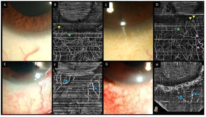 This Eight-panel collage compares slit lamp clinical photographs and anterior segment optical coherence tomography angiography (AS-OCTA) images of the human eye. Panels A–D show normal limbal and perilimbal vasculature. The slit lamp images (A, C) show healthy conjunctival and episcleral vessels. The corresponding OCTA scans (B, D) provide a high-resolution map of the vascular architecture, highlighting hairpin loops at the corneal limbus (yellow arrowheads), radial vessels (green arrowheads), and deeper Y-shaped patterns (pink arrowheads). Panels E–H illustrate eyes with chemical injury. The slit lamp images (E, G) demonstrate conjunctival injection and inflammation. The related OCTA scans (F, H) reveal significant pathological changes, specifically large ischemic zones characterized by a lack of signal (non-perfusion) and distortion of the remaining limbal vasculature (blue arrowheads). This comparison demonstrates the clinical utility of AS-OCTA in assessing ocular surface ischemia and vascular integrity following chemical burns, allowing for more precise quantification of limbal stem cell deficiency risk than conventional slit lamp examination alone.