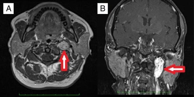 Diagnostic Magnetic Resonance Imaging (MRI) showing a left-sided Tympanojugular Paraganglioma (TJP) in two planes. Image A presents an axial T1-weighted sequence demonstrating a well-defined lesion in the region of the jugular foramen. The lesion exhibits a characteristic 'salt and pepper' appearance, consisting of punctate areas of high signal intensity (likely representing slow-flowing blood or hemorrhage) and low signal voids (representing high-flow vascular channels). Image B presents a coronal T1-weighted fat-suppressed sequence where the lesion demonstrates marked hyperintensity and vertical extension. The mass occupies the skull base and extends inferiorly into the upper neck along the carotid sheath. Key features include its hypervascular nature and its specific location at the jugular bulb, indicative of a glomus jugulare tumor. This imaging is representative of Head and Neck Radiology and Neuroradiology, targeting advanced medical education regarding temporal bone pathologies and neurovascular tumors.