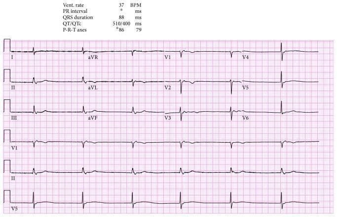 A standard 12-lead electrocardiogram (ECG) displayed on a pink grid, illustrating a severe bradycardia with a heart rate of 37 beats per minute. The rhythm is characterized by a junctional escape rhythm, evidenced by the absence of visible P waves preceding the QRS complexes and a narrow QRS duration of 88 ms. The clinical data printed at the top indicates a QT/QTc interval of 510/400 ms. Morphology analysis shows relatively low QRS amplitude in limb leads with higher amplitudes in precordial leads V4-V6. T waves are upright in lateral leads (I, aVL, V5, V6) and inverted in aVR, with no significant ST-segment elevation or depression noted across the leads. This visual demonstrates common findings associated with sick sinus syndrome or high-grade atrioventricular block where a junctional pacemaker has taken over at its intrinsic slow rate. The image is a primary diagnostic tool for evaluating cardiac rhythm disturbances and conduction system disease in a clinical setting.