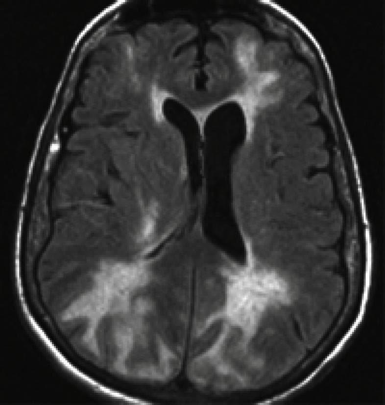 This diagnostic image is an axial T2-weighted or Fluid-Attenuated Inversion Recovery (FLAIR) MRI scan of the brain, demonstrating characteristic findings of Posterior Reversible Encephalopathy Syndrome (PRES). The image reveals prominent, bilateral, patchy areas of hyperintense signal within the cortical and subcortical white matter. These hyperintensities are most pronounced in the posterior regions, specifically the occipital and parietal lobes, though they also extend into the frontal lobes. The lesions represent vasogenic edema and appear as irregular, ill-defined clusters. The ventricular system, including the lateral ventricles, maintains a relatively normal morphology without significant mass effect or midline shift despite the adjacent parenchymal changes. The sulcal and gyral patterns are largely preserved. This imaging modality is essential for identifying the symmetric vasogenic edema typical of PRES, which often presents clinically with encephalopathy, seizures, and visual disturbances associated with acute hypertension or drug toxicity.