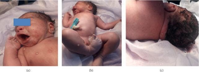 Clinical photographs of a term newborn presenting with a generalized vesiculopustular eruption. The images are divided into three panels: (a) a facial and upper chest view showing multiple erythematous macules and distinct white-to-yellow pustules on the cheeks and torso; (b) a full-body view demonstrating extensive distribution of pustular and bullous lesions across the trunk, abdomen, and lower extremities; (c) a posterior view of the neck and scalp showing isolated pustules. The lesions vary in size from small, tense pustules with turbid contents to larger, fluid-filled bullae. Surrounding the lesions is mild, patchy erythema. The clinical presentation is consistent with neonatal pustular dermatosis, requiring differentiation between infectious etiologies such as bullous impetigo or Congenital Cutaneous Candidiasis, and non-infectious conditions like Erythema Toxicum Neonatorum or Transient Neonatal Pustular Melanosis. This visual serves as an educational reference for neonatal dermatology and the diagnostic evaluation of skin eruptions at birth.
