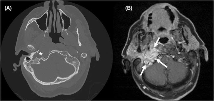 This dual-modality comparison presents axial diagnostic imaging of the head, focusing on the right central skull base. Panel (A) is a non-contrast Computed Tomography (CT) scan in a bone window, clearly demonstrating significant cortical erosion and bony destruction of the right skull base and occipital bone (marked with an asterisk). Panel (B) shows a T1-weighted Dixon Magnetic Resonance Imaging (MRI) sequence at a corresponding anatomical level. The MRI highlights an extensive, hyperintense infiltrating soft tissue mass (indicated by white arrows) involving the right skull base, upper neck, and extending toward the occipital bone and jugular bulb region. The image illustrates the complementary roles of CT for evaluating cortical integrity and MRI for assessing soft tissue infiltration and marrow replacement. Clinically, these findings are characteristic of skull base osteomyelitis (e.g., malignant otitis externa) or aggressive neoplastic processes. Anatomical landmarks visible include the maxillary sinuses, sphenoid bone, and posterior fossa structures.