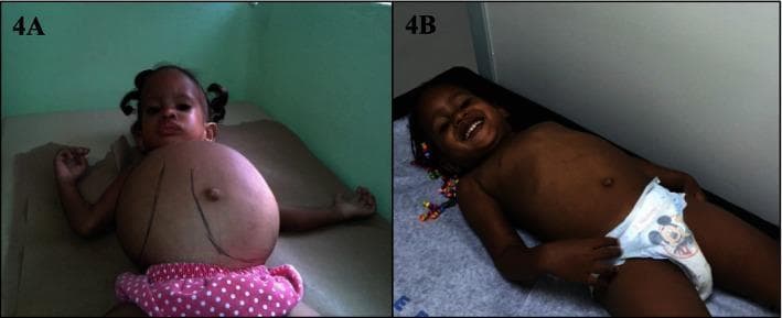This clinical photograph comparison (A and B) illustrates the physical manifestations and therapeutic response of a pediatric patient with Gaucher disease. Image A shows a child with severe abdominal distension, representing massive hepatosplenomegaly. Visible dark markings on the skin indicate the anatomical borders of the enlarged liver and spleen prior to medical intervention. Image B displays the same child following enzyme replacement therapy (ERT), demonstrating a significant reduction in abdominal girth and regression of hepatosplenomegaly to a more typical size. The comparison highlights the clinical efficacy of ERT in managing visceral symptoms of lysosomal storage disorders. Beyond the physiological changes, there is a notable improvement in the child's apparent comfort and affect, transitioning from a neutral/stressed state in A to a comfortable, smiling appearance in B. This visual is used in medical education to teach the clinical presentation of metabolic genetic diseases and the impact of systemic targeted therapies.