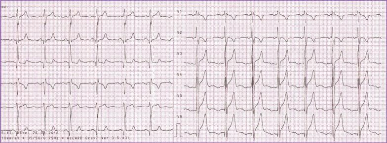 Diagnostic image showing a standard 12-lead electrocardiogram (ECG) recorded at a speed of 25 mm/s and calibration of 10 mm/mV. The tracing demonstrates features of biventricular hypertrophy. Key findings include tall R-waves in the mid-to-left precordial leads (V3-V6) with very high amplitude, suggestive of left ventricular hypertrophy, and a slight right-axis deviation in the frontal plane. Lead V1 exhibits a fractionated QRS complex and prominent S-waves. Secondary repolarization abnormalities are present, characterized by ST-segment depression and T-wave inversion across the precordial leads V3-V6 and in lead III, indicating ventricular strain. The rhythm is sinus with a regular rate; P-waves are visible and positive in leads I and II. This ECG provides a classic clinical example of biventricular enlargement often associated with congenital heart diseases like ventricular septal defects with significant shunting.