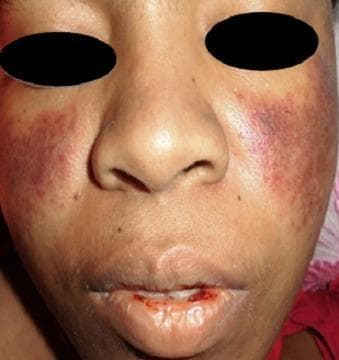 A clinical photograph of a patient's face demonstrating dermatological and mucosal manifestations of Systemic Lupus Erythematosus (SLE). A classic malar rash (butterfly rash) is present, characterized by symmetric, erythematous-to-violaceous patchy lesions over the malar eminences and the bridge of the nose, notably sparing the nasolabial folds. Additionally, the perioral region exhibits significant erythema and mucosal involvement. The lips show evidence of hemorrhagic lesions, with visible blood crusting and a small fissure on the lower lip, suggestive of vasculitis or active systemic inflammation. These visual findings are key diagnostic indicators for SLE, particularly when associated with hematological abnormalities such as thrombocytopenia. The photograph provides a clear example of cutaneous lupus manifestations for clinical diagnosis and medical education.