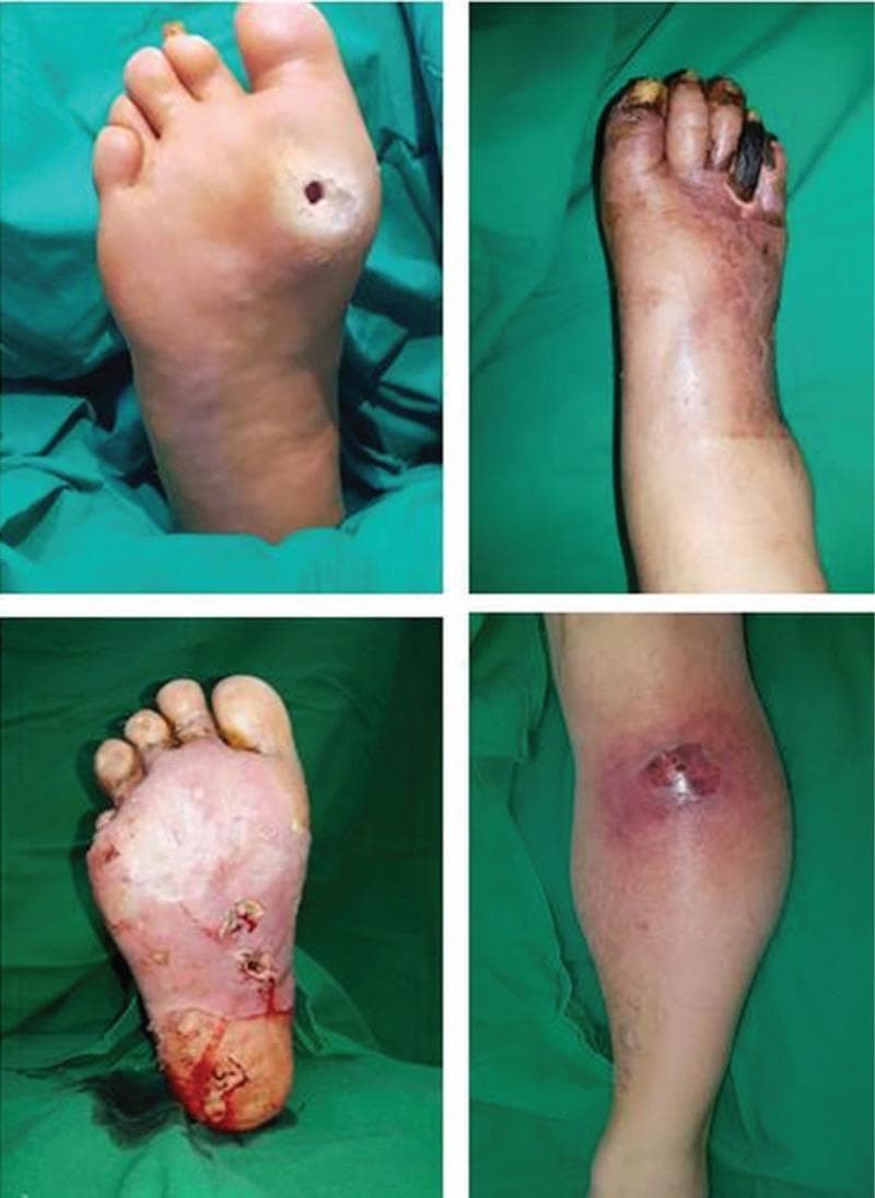 This set of four clinical photographs illustrates various stages and manifestations of diabetic foot complications. (Top-left): A plantar surface view showing a classic neuropathic ulcer. The wound is small, circular, and deep with a hyperkeratotic rim, located over a high-pressure area (the metatarsal head). (Top-right): A dorsal view of a foot exhibiting dry gangrene and critical limb ischemia. The distal phalanges are blackened, shriveled, and necrotic, with proximal cyanotic and erythematous skin changes indicating impaired perfusion. (Bottom-left): A plantar view demonstrating extensive tissue infection with an abscess forming within a large, macerated open wound. It shows pale granulation tissue, purulent exudate, and multiple sinus tracts, suggesting deep-seated infection. (Bottom-right): A lower leg view showing an abscess within a closed wound. This is characterized by localized swelling, a central focus of purulence/necrosis, and a prominent circumferential erythematous halo indicating cellulitis and acute inflammatory response. These images collectively demonstrate the progression from simple ulceration to complex infectious and ischemic complications in diabetic patients.