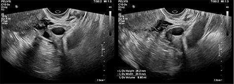 This diagnostic image consists of two side-by-side transvaginal pelvic ultrasound views of the right adnexa. The scan reveals a unilocular simple cyst within the right ovary. Visually, the cyst is characterized by a well-defined, thin, smooth wall and a purely anechoic (black) internal lumen, signifying clear fluid content without internal septations, papillary projections, or solid mural components. Acoustic enhancement is visible deep to the cyst, a typical finding for fluid-filled structures. The surrounding ovarian stroma and adjacent pelvic soft tissues exhibit heterogeneous, intermediate echogenicity. Measurement markers on the second frame assist in determining the volume and dimensions of the cyst. This image serves as a clinical example of a benign-appearing ovarian cyst, used in gynecological education to differentiate simple cysts from complex tubo-ovarian masses or hydrosalpinx.