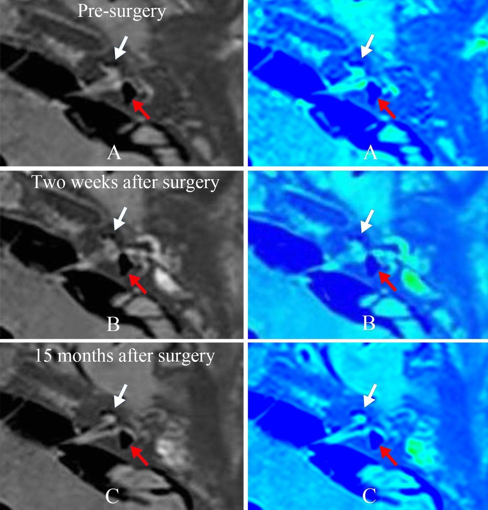 Diagnostic axial MRI scans of the inner ear illustrating endolymphatic hydrops (EH) in a patient with Ménière’s disease across three time intervals: pre-surgery (A), two weeks post-surgery (B), and 15 months post-surgery (C). The left column displays grayscale gadolinium-enhanced MRI (Gd-MRI) using a three-dimensional real inversion recovery sequence. White arrows indicate the cochlea, and red arrows indicate the vestibule. The right column provides corresponding pseudocolor images where blue represents the endolymphatic space and green represents the perilymphatic space. In the pre-surgery baseline (A), significant cochlear and vestibular hydrops are visible, characterized by the expansion of the endolymphatic (blue) compartments at the expense of the perilymphatic (green) areas. Sequential follow-up images (B and C) demonstrate a consistent appearance with no significant reduction or change in the degree of hydrops following endolymphatic sac decompression (ESD) surgery. This comparison illustrates a case where surgical intervention did not result in visual anatomical reversal of fluid compartment distention, serving as a radiological reference for post-operative monitoring of inner ear pathology.
