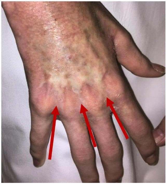This clinical photograph displays the dorsal aspect of a human hand, illustrating the dermatological regression of sclerodermatous chronic Graft-versus-Host Disease (cGvHD). The skin exhibits significant pigmentary alterations and textural changes following treatment. Three red arrows point to residual areas of fibrotic thickening over the metacarpophalangeal joints, which appear as slightly hypopigmented, indurated patches compared to the surrounding mottled, erythematous, and hyperpigmented skin. The overall appearance demonstrates a transition from severe cutaneous fibrosis toward clinical resolution, though residual dyspigmentation and uneven skin texture persist. This image serves as an educational example of the clinical evolution of skin involvement in systemic cGvHD post-immune ablation and stem cell rescue, highlighting the characteristic scleroderma-like features and their potential for regression.