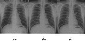 This Comparison Chart features a side-by-side display of three posteroanterior (PA) chest radiographs of a 42-year-old male, labeled (a), (b), and (c). The images serve as a technical demonstration of diagnostic imaging evolution, specifically comparing traditional screen-film (S/F) technology with Fuji Computed Radiography (FCR) systems. Visible anatomical structures across all three panels include the lung fields, cardiac silhouette, mediastinum, diaphragm, and rib cage. The lung fields are radiolucent, showing branching pulmonary vascular markings. The central radiopaque structures consist of the heart and mediastinal great vessels. Diaphragmatic contours are clearly defined above the abdominal cavity. The educational focus is on image quality metrics: panel (a) shows traditional screen-film results; panel (b) uses FCR 5000 technology; and panel (c) uses the FCR 5501D system. There is a progressive increase in edge sharpness, contrast, and signal-to-noise ratio from (a) to (c), with (c) providing the most detailed visualization of fine pulmonary markings and interstitial textures due to advanced dual-side phosphor plate scanning. This material is suitable for radiology and medical physics students studying imaging modality optimization.