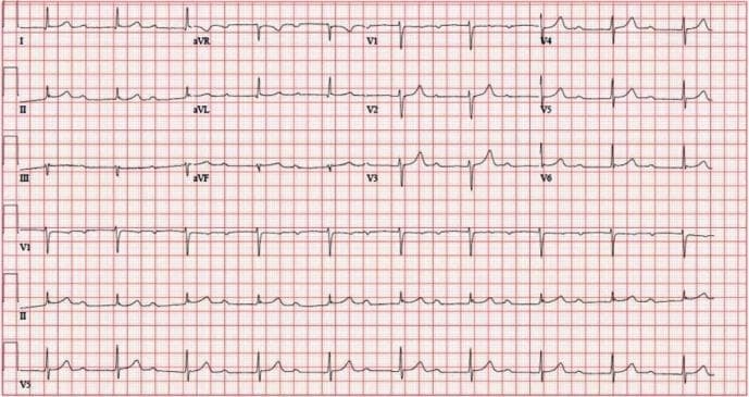 A 12-lead electrocardiogram (ECG) printed on standard grid paper demonstrating a regular sinus rhythm with a diagnostic finding of first-degree atrioventricular (AV) block. The primary characteristic is a markedly and uniformly prolonged PR interval, measured at 512 ms, visible across all limb (I, II, III, aVR, aVL, aVF) and precordial (V1-V6) leads. Each P wave is followed by a QRS complex, indicating 1:1 AV conduction without dropped beats. The QRS complexes exhibit normal morphology, narrow width, and expected axis, with typical R-wave progression in the precordial leads and no evidence of bundle branch blocks. This diagnostic image serves as a clinical example of significant conduction delay in the AV node, useful for teaching ECG interpretation of bradyarrhythmias and heart block classifications. The rhythm strips at the bottom provide a continuous view of the prolonged PR relationship over multiple cardiac cycles.