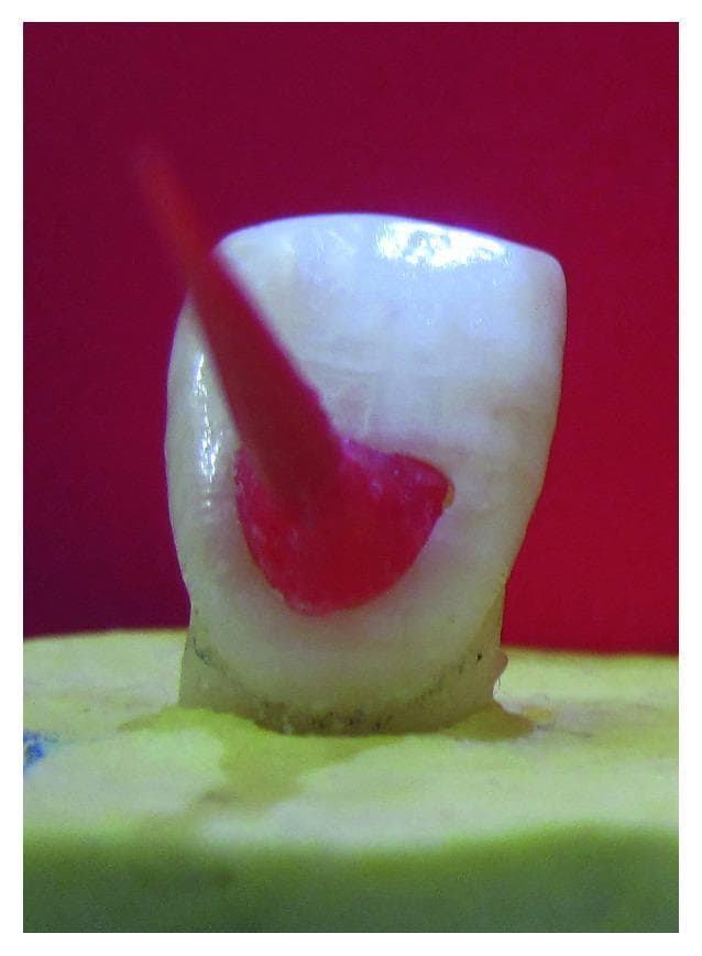 Clinical photograph of a laboratory specimen demonstrating dental cavity preparation and template fabrication. The image shows an extracted human maxillary central incisor crown mounted on a yellow dental stone base. A Class V cavity preparation is visible on the facial surface of the tooth crown, characterized by smooth internal walls and a defined cavosurface margin. A red autopolymerized acrylic resin (GC Pattern Resin) has been applied within the prepared cavity to serve as a standardized template. A slender, cylindrical handling pin or instrument is embedded into the red resin, extending coronally to facilitate the removal and placement of the template. This setup is utilized in restorative dentistry research to ensure uniformity in cavity dimensions across multiple specimens for testing composite filling or porcelain laminate veneer (PLV) protocols. The contrast between the off-white tooth structure and the red resin highlights the precise fit of the guide within the dental preparation.