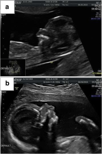 This diagnostic image consists of two sagittal-view prenatal ultrasound frames (a and b) illustrating fetal facial dysmorphism across different gestational periods. Image (a) captures a first-trimester scan displaying an atypical facial profile with subtle irregularities in the midface and mandibular region. Image (b) shows a second-trimester scan where craniofacial anomalies are more pronounced. Significant diagnostic findings in frame (b) include micrognathia (a severely receding and underdeveloped mandible) and nasal bone hypoplasia (marked by a deficient or absent ossification of the nasal bridge). These findings are critical markers in obstetric imaging for genetic syndromes, such as Pierre Robin sequence or chromosomal microdeletions. The comparison highlights the progressive visibility of skeletal dysmorphology during fetal development, serving as a pedagogical tool for identifying facial markers of congenital anomalies in maternal-fetal medicine.