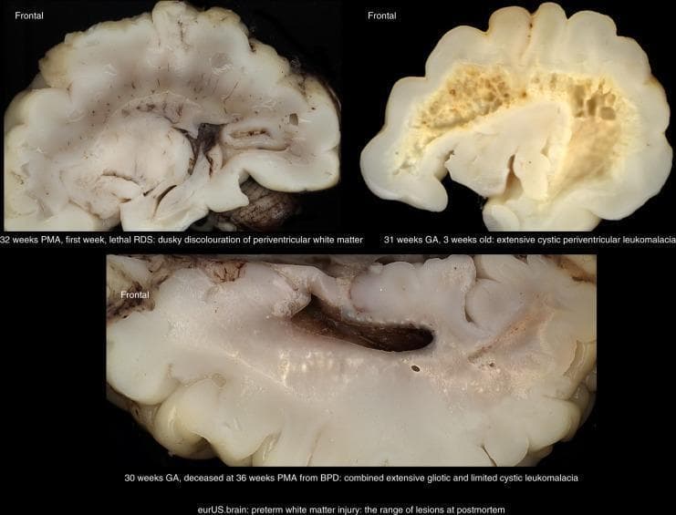 This clinical photograph displays three postmortem frontal brain sections from preterm infants, illustrating the spectrum of preterm white matter injury (WMI). The top-left specimen (32 weeks PMA) demonstrates mild injury characterized by dusky discoloration of the periventricular white matter without focal necrosis. The top-right specimen (31 weeks GA) shows severe cystic periventricular leukomalacia (PVL), featuring extensive, well-defined cystic formations and a spongy texture that disrupts the normal tissue architecture. The bottom specimen (30 weeks GA, deceased at 36 weeks PMA) displays a chronic stage of injury with combined extensive gliotic changes (glial scarring) and limited cystic leukomalacia, indicating both focal and diffuse white matter damage. These specimens serve as pathological correlates for imaging findings such as periventricular hyperechogenicity on cranial ultrasound (CUS) and signal abnormalities on MRI. The image highlights the morphological differences between non-cystic WMI, characterized by gliosis, and cystic PVL, which is associated with more severe clinical outcomes like spastic bilateral cerebral palsy.