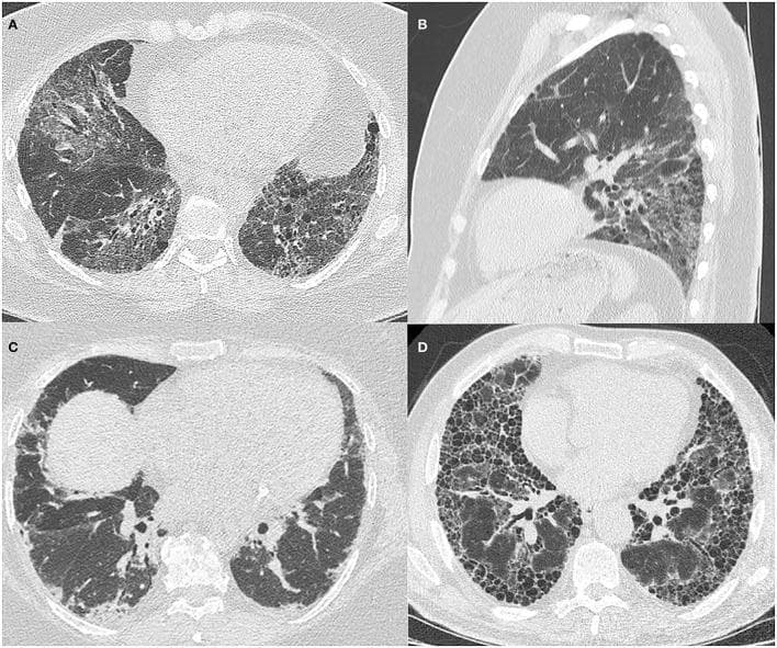 This composite of High-Resolution Computed Tomography (HRCT) images illustrates diverse patterns of Interstitial Lung Disease (ILD) associated with Antisynthetase Syndrome (ASyS). Panel A (axial) and B (sagittal) depict fibrotic Non-Specific Interstitial Pneumonitis (NSIP), characterized by bilateral, patchy ground-glass opacities, fine reticulation, and traction airway dilatation, with a clear lower zone predominance visible in the sagittal reconstruction. Panel C displays an Organizing Pneumonitis (OP) pattern, showing patchy, peripheral, and basal-predominant lung consolidation. Panel D demonstrates a Usual Interstitial Pneumonitis (UIP) pattern, featuring advanced fibrotic changes including subpleural and basal-predominant reticulation and extensive honeycombing. These images serve as an educational comparison of radiological manifestations in connective tissue disease-related ILD (CTD-ILD), highlighting key diagnostic features such as ground-glass opacification, architectural distortion, and honeycombing across different pathological patterns in patients with anti-Jo1 antibodies.