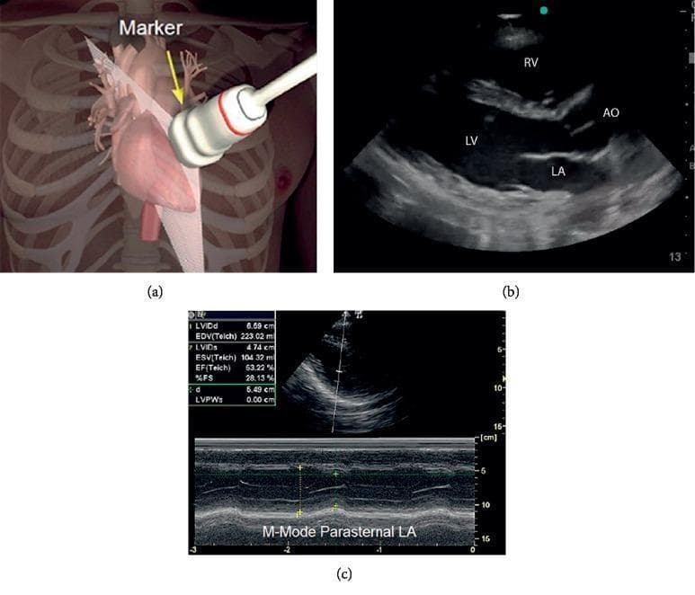 This composite educational graphic illustrates the procedure and output of a cardiac ultrasound examination. Panel (a) is an anatomical diagram showing a hand-held ultrasound transducer placed at the left parasternal position (4th-5th intercostal space) of a 3D chest model, with a yellow arrow indicating the probe marker. Panel (b) shows a corresponding 2D echocardiogram in a parasternal long-axis (PLAX) view, with visible cardiac structures labeled: Left Ventricle (LV), Right Ventricle (RV), Left Atrium (LA), and Aorta (AO). Panel (c) demonstrates an M-mode ultrasound capture at the level of the left atrium and left ventricle. This 1D imaging modality records cardiac wall motion and chamber dimensions over time. The image includes quantitative data for assessing systolic function, such as Ejection Fraction (EF by Teichholz method), Left Ventricular Internal Diameter at end-diastole (LVIDd) and end-systole (LVIDs), and Fractional Shortening (%FS). This visual set teaches the correlation between probe placement, spatial anatomical imaging, and temporal quantitative cardiac assessment.