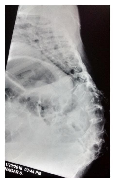 Lateral view X-ray of the thoracolumbar spine demonstrating a severe reversal of physiological spinal curvature. The thoracic region exhibits an atypical inward concavity (lordosis), while the lumbar region shows a pronounced outward convexity (kyphosis), creating a large gibbus deformity in the lumbosacral junction. The vertebral bodies appear crowded and irregular, with visible loss of intervertebral disc space in the affected segments. These structural findings are clinically consistent with sequelae of spinal tuberculosis (Pott's disease), resulting in a 'kyphotic pelvis' and significant skeletal remodeling. The image illustrates advanced orthopedic pathology and its impact on sagittal alignment, often leading to restricted pulmonary function and obstetric complications such as obstructed labor.