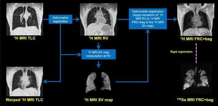 This medical flow diagram illustrates a multi-step image registration workflow used to generate 1H-MRI-specific ventilation (SV) maps. The flowchart tracks the processing of coronal thoracic MRI slices through various respiratory states. Primary inputs include '1H MRI TLC' (Total Lung Capacity) showing expanded lung volumes and a low-riding diaphragm, and '1H MRI RV' (Residual Volume) showing contracted lung volumes with a superiorly displaced diaphragm. The workflow utilizes 'Deformable registration' to align the TLC and RV scans, resulting in a 'Warped 1H MRI TLC' image that matches the RV geometry. From these registered datasets, a '1H MRI SV map' is computed, which provides a functional representation of regional lung ventilation, appearing as a segmented intensity map. The process further incorporates functional 129Xe MRI (acquired at Functional Residual Capacity plus bag) via 'Rigid registration' to an anatomical '1H MRI FRC+bag' reference. This workflow demonstrates the integration of anatomical proton MRI and functional hyperpolarized gas MRI for advanced pulmonary diagnostic imaging and quantification of regional ventilation defects.