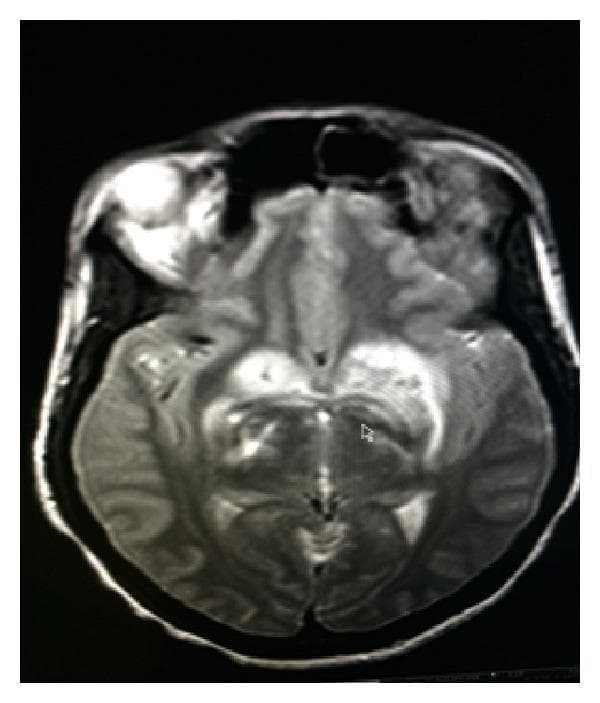 This diagnostic image is an axial T2-weighted Magnetic Resonance Image (MRI) of the brain at the level of the basal ganglia. The image reveals diffuse areas of high signal intensity (hyperintensity), particularly prominent within the basal ganglia and extending into the surrounding white matter. These findings are highly characteristic of vasogenic edema, indicating extracellular fluid accumulation often associated with blood-brain barrier disruption. There is evidence of mild to moderate mass effect in the left hemisphere, manifesting as subtle expansion of the involved tissue and slight compression of the adjacent cerebral structures, although the midline appears relatively stable in this specific slice. The hyperintensities are asymmetric, appearing more extensive in the left hemisphere. This imaging is clinically significant for identifying secondary complications of intracranial pathology, such as neuroinfection or inflammatory processes, and is used to monitor response to anti-edema treatments like dexamethasone or mannitol.