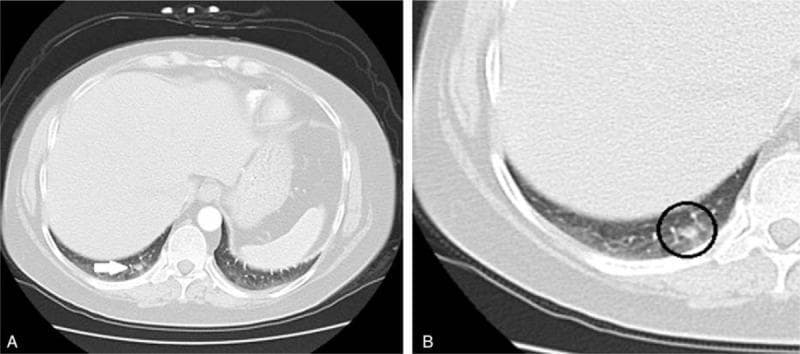 Diagnostic axial chest CT scan in lung windows demonstrating a solitary pulmonary nodule in the right lower lobe. Image A provides a broad overview of the lower thorax at the level of the diaphragm, where a white arrow indicates a 17 x 15 mm peripheral opacity. Image B presents a magnified view of the same lesion (circled), allowing for detailed assessment of its morphology. The nodule is located in the medial aspect of the lung base, adjacent to the right diaphragmatic crus. Visually, the lesion is well-defined but exhibits slightly irregular or lobulated margins with heterogeneous internal density relative to the surrounding aerated lung parenchyma. In a clinical context of ACTH-dependent Cushing syndrome, such a finding is highly significant as a potential source of ectopic ACTH secretion. This image serves as a teaching tool for identifying small solitary pulmonary nodules and emphasizes the importance of magnification in characterizing nodule margins and internal structure for oncological and endocrinological workups.