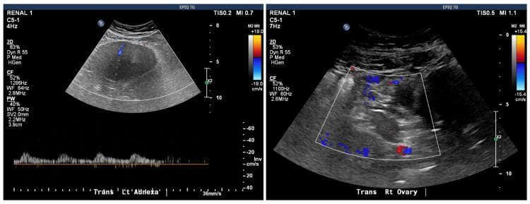 This diagnostic image consists of two side-by-side transabdominal pelvic ultrasound panels with color Doppler flow assessment, comparing the bilateral adnexa. The left panel, labeled 'Trans L’t Adnexa,' displays a large, hypoechoic, and relatively homogeneous mass. The superimposed color Doppler reveals a significant absence of internal vascularity, with only a negligible blue signal visible, and the corresponding pulsed-wave Doppler at the bottom shows minimal spectral activity, a finding highly suggestive of ovarian torsion. In contrast, the right panel, labeled 'Trans Rt Ovary,' shows a more heterogeneous ovarian structure with robust color Doppler signals (red and blue), indicating preserved arterial and venous blood flow. This side-by-side comparison serves as a classic educational example of how Doppler sonography is used to evaluate suspected adnexal torsion by demonstrating the loss of blood flow to the affected organ compared to the normal contralateral ovary. The image is relevant for gynecology and emergency medicine training regarding the diagnosis of acute pelvic pain.