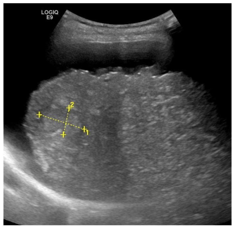 This diagnostic B-mode transabdominal ultrasound image displays the right lobe of the liver in a patient with Non-Alcoholic Fatty Liver Disease (NAFLD) progressing to cirrhosis. Key sonographic features include a markedly nodular and irregular liver surface, which is a pathognomonic indicator of advanced cirrhosis. The liver parenchyma exhibits an inhomogeneous, coarse echotexture with increased echogenicity relative to normal tissue. An anechoic layer of perihepatic ascites is visible between the abdominal wall and the liver capsule, enhancing the visualization of the surface nodularity. Within the right lobe, a discrete, hypoechoic focal lesion is identified and demarcated with yellow measurement calipers (labeled 1 and 2), representing a finding highly suspicious for hepatocellular carcinoma (HCC) in the clinical context of cirrhosis. This image serves as an educational tool for identifying the complications of chronic liver disease, specifically the morphological transition from steatosis to cirrhosis and secondary malignancy.
