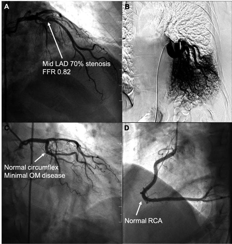 This composite diagnostic image consists of four panels (A-D) showcasing results from cardiac catheterization and aortography. Panel A: Coronary angiogram of the left coronary artery system demonstrating a 70% mid-segment stenosis in the left anterior descending (LAD) artery, annotated with a fractional flow reserve (FFR) of 0.82. Panel B: Aortogram revealing an anomalous systemic feeding artery originating from the descending thoracic aorta and supplying the lower lobe of the left lung, a pathognomonic finding for intralobar pulmonary sequestration. Panel C: Left coronary angiogram highlighting a normal circumflex branch with minimal disease in the obtuse marginal (OM) branches. Panel D: Right coronary angiogram showing a normal, patent right coronary artery (RCA) with typical C-shaped morphology and branching. This educational visual contrasts coronary atherosclerotic disease with congenital vascular anomalies like pulmonary sequestration, demonstrating the utility of invasive angiography in diagnosing both cardiac and extra-cardiac thoracic vascular conditions.