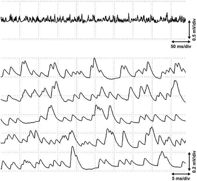 This diagnostic image displays a multi-channel electrophysiological recording of miniature end plate potentials (MEPPs) captured from the end plate zone of the biceps brachii muscle. The upper panel shows a continuous single-channel trace at a scale of 0.5 mV/div and 50 ms/div, illustrating high-frequency, low-amplitude baseline activity known as end plate noise. The lower panel provides a high-resolution, five-channel synchronized view at 0.2 mV/div and 5 ms/div, specifically detailing numerous large and partially stratified MEPPs. These spontaneous postsynaptic potentials are characterized by rapid upward deflections followed by a slower, non-linear decay to baseline. Notable features include the absence of elicited postsynaptic action potentials or 'end plate spikes' despite the high-frequency sequence of potentials. This recording illustrates the physiological spontaneous release of acetylcholine at the neuromuscular junction in an active site, useful for differentiating between normal end plate activity and pathological spontaneous discharges in clinical electromyography (EMG).
