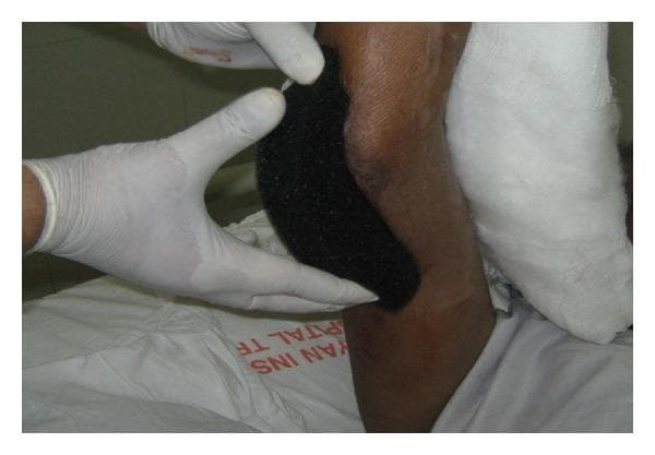 Clinical photograph of a medical professional's gloved hands applying a black, open-cell polyurethane foam dressing to a large wound on a patient's limb, likely the forearm or elbow area. The dressing is a key component of Vacuum-Assisted Closure (VAC) therapy, also known as Negative Pressure Wound Therapy (NPWT). The foam has a distinctive porous, sponge-like texture designed to distribute sub-atmospheric pressure evenly across the wound bed, stimulating granulation tissue formation and removing exudate. The foam appears customized and cut to fit the specific irregular dimensions of the skin lesion. The surrounding skin is of a dark complexion, and a white gauze bandage is visible proximally. This visual demonstrates a critical step in advanced wound care management for complex or chronic wounds, such as grade III open fractures or post-debridement surgical sites, highlighting the application technique and structural properties of hydrophobic open-pore foam interfaces.