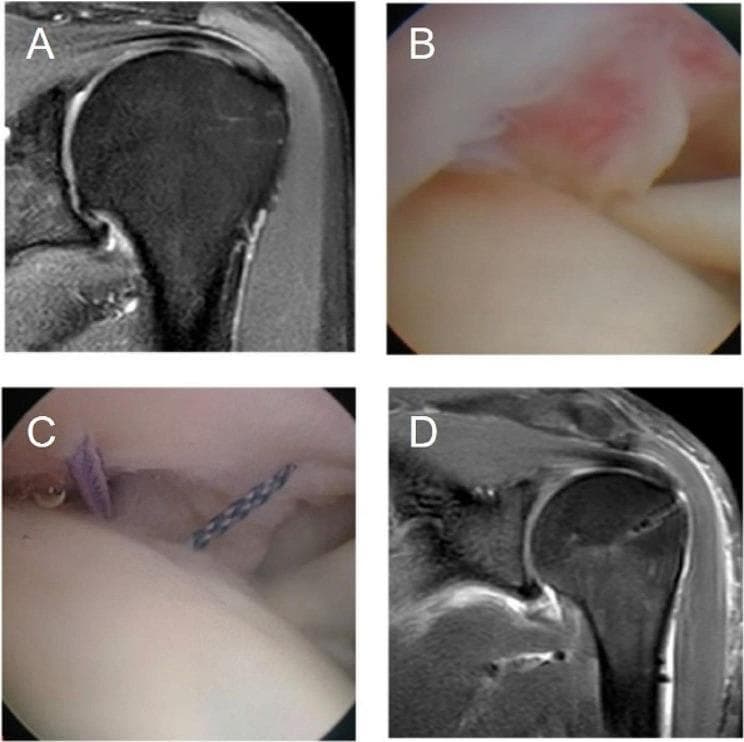 A multi-panel medical image sequence illustrating the diagnosis and surgical repair of a rotator cuff injury. (A) Coronal T2-weighted MRI of the shoulder showing an Ellman III partial articular-sided supraspinatus tendon tear, characterized by a focal high-signal defect at the tendon's footprint. (B) Intraoperative arthroscopic view from the glenohumeral joint confirming the partial articular-sided supraspinatus tendon tear with visible tissue fraying and hyperemia. (C) Intraoperative arthroscopic view demonstrating the surgical intervention, where purple and braided sutures are introduced through the tendon into the joint space as part of a trans-tendon repair technique. (D) Postoperative coronal T2-weighted MRI showing a restored tendon footprint with resolved signal intensity defects, indicating a successful rotator cuff repair. A hypointense linear artifact in the humeral head suggests the presence of a suture anchor. This sequence is intended for orthopedic education, specifically focusing on the management of partial-thickness rotator cuff tears through arthroscopic techniques.
