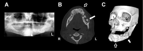 Multi-panel diagnostic imaging of the maxillofacial region demonstrating florid cemento-osseous dysplasia (FCOD) complicated by osteomyelitis. Panel A: A panoramic radiograph showing extensive, well-demarcated mixed radiolucent and radiopaque lesions involving all four quadrants of the mandible and maxilla. The denser opacities present a characteristic 'cotton-wool' appearance surrounded by thin radiolucent rims. Panel B: Axial CT scan highlighting generalized hypertrophic and heterogeneous sclerotic changes within the mandible (open arrow). A significant lytic lesion with cortical loss and central sclerosis is visible in the left mandibular body (solid arrow), indicating secondary infection. Panel C: A 3D reconstructed CT image illustrating global bony expansion and contour irregularities in the maxilla and mandible (open arrow). A focal area of erosion on the left mandible (solid arrow) corresponds to the site of Actinomyces osteomyelitis. This series serves as an educational example of how underlying fibro-osseous dysplasia can predispose patients to secondary infections due to decreased vascularity of the sclerotic bone.