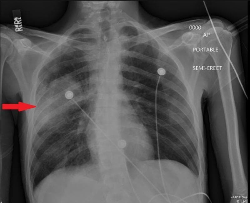 This diagnostic image is a portable anteroposterior (AP) chest X-ray of a human male in a semi-erect position. The primary finding is a focal area of increased opacity in the right mid-lung zone, indicated by a red arrow, which is characteristic of consolidation in the right middle lobe. This infiltrate suggests an infectious process such as community-acquired pneumonia. The left lung field remains relatively clear. Several non-anatomical features are present, including radiopaque monitoring electrodes (ECG leads) with associated wiring across the chest and a 'RIGHT' (R) marker in the upper left corner. The image labels 'PORTABLE' and 'SEMI-ERECT' provide clinical context regarding the acquisition technique in an emergency or acute care setting. This visual is used for teaching the radiological presentation of lobar pneumonia and the identification of anatomical versus non-anatomical structures on a portable chest radiograph.
