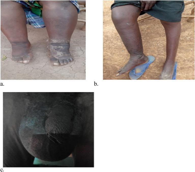 This set of clinical photographs illustrates chronic manifestations of lymphatic filariasis, a parasitic disease caused by Wuchereria bancrofti. Image (a) shows bilateral lymphedema of the lower extremities, characterized by significant swelling (elephantiasis) extending from the feet to the lower legs, with visible skin thickening, hyperkeratosis, and textural changes. Image (b) demonstrates unilateral lymphedema, where the right lower extremity exhibits marked enlargement and swelling compared to the relatively normal left leg. Image (c) displays severe scrotal swelling, indicative of a large hydrocele. The scrotal sac is massively distended, obscuring normal genital contours due to lymphatic fluid accumulation. These images highlight the progressive morbidity and physical deformities associated with untreated chronic lymphatic obstruction in endemic regions. The visuals serve as educational markers for late-stage morbidity management and disability prevention (MMDP) in tropical medicine.