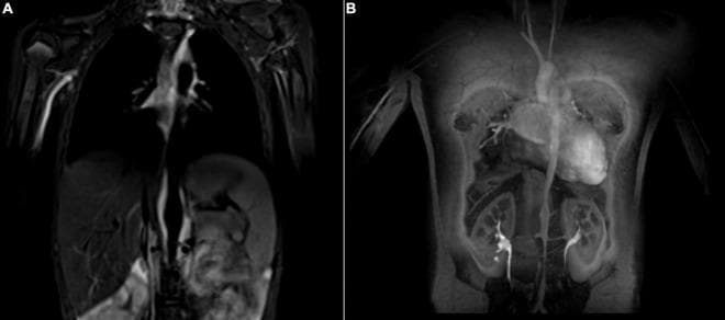 Diagnostic Image: Coronal Magnetic Resonance Imaging (MRI) and Magnetic Resonance Angiography (MRA) of the thorax and abdomen in a pediatric patient with Takayasu arteritis. Panel A displays a T2-weighted black blood sequence showing mural hypersignal along the abdominal aorta, indicative of active vessel wall inflammation and edema. Panel B presents a post-contrast MR angiogram showing the luminal morphology. Key findings include multifocal segmental narrowing (stenosis) of the mid-to-distal abdominal aorta and bilateral narrowing of the renal arteries. The aortic arch and proximal thoracic aorta appear relatively spared compared to the infra-diaphragmatic involvement. The image illustrates classic features of large-vessel vasculitis, highlighting the importance of using multi-sequence MRI to evaluate both vessel wall inflammation (wall thickening/edema) and luminal consequences (stenosis or occlusion). This case is representative of childhood-onset Takayasu arteritis affecting the abdominal aorta and its major branches.