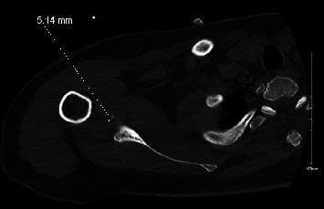 This diagnostic image is an axial Computed Tomography (CT) scan of the right shoulder in a postreduction state. The imaging demonstrates the transverse anatomy of the glenohumeral joint, including the humeral head and the glenoid process of the scapula. A key pathological finding is the presence of multiple small, discrete bony fragments measuring approximately 5.14 mm (annotated with a measurement line) located at the anterior-inferior aspect of the glenoid rim. These findings are diagnostic of a bony Bankart lesion, which represents an avulsion fracture of the glenoid rim typically occurring during an anterior shoulder dislocation. The humeral head is currently reduced within the glenoid fossa, though the presence of these fragments indicates significant joint instability and bone loss. This image is used in orthopedics and radiology to evaluate glenoid integrity and the necessity for surgical stabilization, such as a Latarjet procedure, in the context of recurrent shoulder instability.