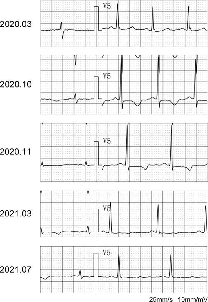 This Comparison Chart displays serial electrocardiogram (ECG) strips of the V5 lead from a single patient across five time points (March 2020 to July 2021). The educational focus is the visual progression of R-wave voltage changes in lead V5 (RV5) related to heart failure and subsequent recovery. In 2020.10, the RV5 amplitude significantly exceeds 2.5 mV (high voltage), accompanied by ST-segment depression and T-wave inversion, findings consistent with left ventricular hypertrophy (LVH) and strain during acute heart failure. The 2020.10 strip also shows shorter R-R intervals, indicating tachycardia. Following the initiation of heart failure treatment and switching anti-tumor therapy, subsequent strips (2020.11 through 2021.07) demonstrate a gradual reduction in R-wave amplitude and a return of the ST-T segment toward baseline, reflecting myocardial recovery. The ECG calibration is standard at 25 mm/s paper speed and 10 mm/mV sensitivity. This visual material is used in cardiology and oncology to illustrate drug-induced cardiotoxicity and the efficacy of therapeutic intervention.