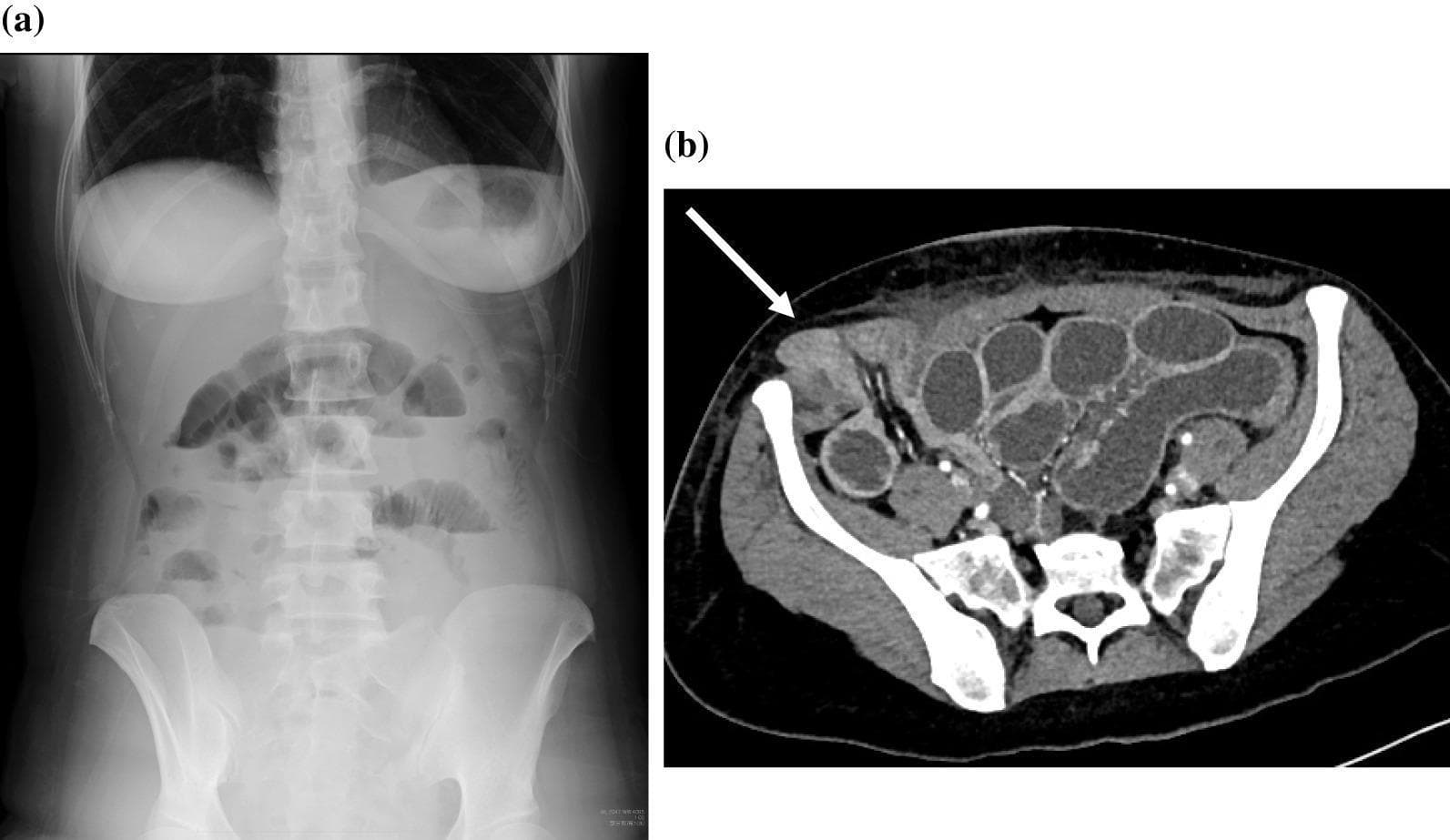 This composite diagnostic image illustrates a case of small bowel obstruction secondary to a trocar site hernia. (a) Anteroposterior erect abdominal radiograph (X-ray) demonstrating multiple dilated loops of small bowel with prominent air-fluid levels. These horizontal interfaces indicate the pathologic accumulation of gas and liquid, a classic sign of mechanical bowel obstruction. (b) Axial contrast-enhanced computed tomography (CT) scan of the lower abdomen and pelvis. The image shows multiple dilated, fluid-filled small bowel loops within the abdominal cavity. A white arrow specifically indicates a segment of small bowel that has herniated through a defect in the abdominal wall fascia at a previous 12-mm lateral trocar site. The herniated loop is visible in the subcutaneous space, superficial to the fascial plane, confirming a trocar site hernia (TSH). The imaging highlights the progression from clinical signs of ileus on plain film to a definitive anatomical diagnosis of strangulated or obstructed hernia on CT, emphasizing postoperative complications of laparoscopic surgery.