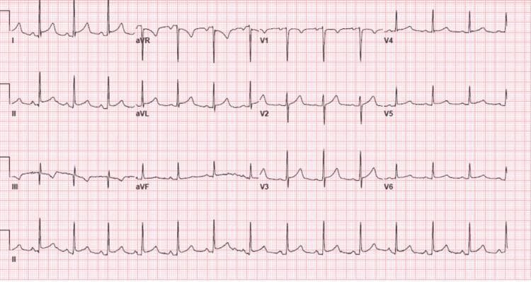 This diagnostic image is a standard 12-lead electrocardiogram (ECG) displayed on a traditional grid background. The tracing demonstrates a normal sinus rhythm with characteristic features of acute pericarditis. Primary findings include diffuse, concave-upward (saddle-shaped) ST-segment elevation visible across multiple vascular territories, specifically in limb leads I, II, III, aVF, and precordial leads V2 through V6. Correspondingly, lead aVR shows reciprocal ST-segment depression. A highly specific finding for pericarditis is the presence of PR-segment depression, most notably seen in leads II, III, aVF, and V4-V6, while lead aVR displays reciprocal PR-segment elevation. The baseline rhythm is stable with a normal QRS morphology and no evidence of localized pathological Q-waves. This ECG serves as a classic educational example for distinguishing inflammatory pericardial processes from acute myocardial infarction through the diffuse nature of the ST changes and the presence of PR-segment shifts.