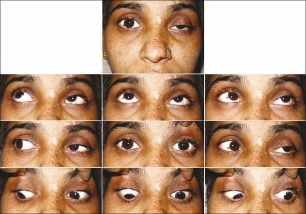 A composite clinical photograph illustrating ophthalmoplegia and ptosis in a patient with Herpes Zoster Ophthalmicus (HZO) and Orbital Apex Syndrome. The top panel shows a primary position view with significant left-sided blepharoptosis. The subsequent nine-gaze montage demonstrates a comprehensive ocular motility assessment. Findings include severe restriction of the left eye in all cardinal directions of gaze (superior, inferior, lateral, and medial), indicating multiple cranial nerve involvement (III, IV, and VI). The right eye shows normal range of motion. The skin of the left forehead and periocular region shows signs of resolving vesiculopustular lesions and post-inflammatory pigmentary changes, characteristic of the ophthalmic division of the trigeminal nerve (V1) involvement. This educational visual represents the clinical presentation of orbital apex syndrome, highlighting the functional deficits in extraocular muscles and eyelid elevation following viral infection in an immunocompromised context.