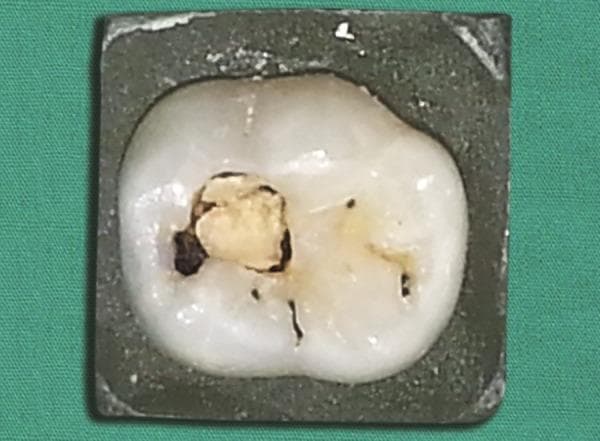 This clinical photograph displays a human primary molar tooth isolated in a dark mounting block for dental study. The tooth exhibits a significant carious lesion on the occlusal surface. The primary pathology is a large, central cavitation containing yellowish-brown carious dentin, which appears soft and necrotic. Dark staining and demineralization are visible along the margins of the cavity, indicating progressive dental decay. Additionally, secondary features include smaller dark pits and fissures with incipient caries or staining. The tooth crown displays multi-cusp morphology characteristic of a posterior tooth. This image serves as a visual reference for dental caries classification, demonstrating advanced enamel and dentin destruction in primary dentition, likely used for teaching diagnostic criteria in pediatric dentistry or restorative treatment planning.
