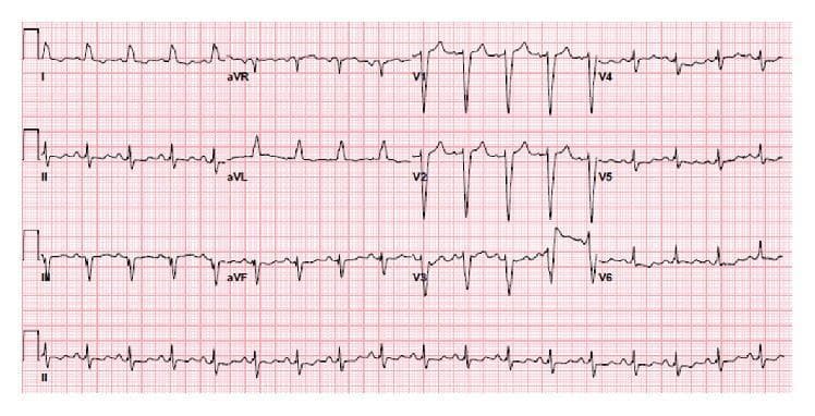 This diagnostic image is a 12-lead electrocardiogram (ECG) performed on standard grid paper, demonstrating a classic Left Bundle Branch Block (LBBB) pattern. The rhythm is sinus, with visible P-waves preceding each QRS complex. Key diagnostic features include a significantly widened QRS duration (>120 ms) and broad, monophasic R-waves in the lateral leads (I, aVL, V5, and V6). In the precordial leads V1-V3, there is a characteristic deep, wide S-wave and predominantly negative deflection, indicating abnormal intraventricular conduction. Secondary ST-T wave changes are present, manifested by ST-segment flattening and T-wave inversions discordant with the QRS complex in the lateral leads, which is typical for LBBB morphology. This tracing is an educational example of preexisting conduction system disease that may predispose patients to complete heart block during clinical procedures, such as central venous cannulation. The ECG provides a basis for recognizing ventricular depolarization abnormalities and differentiating LBBB from other cardiac conditions.