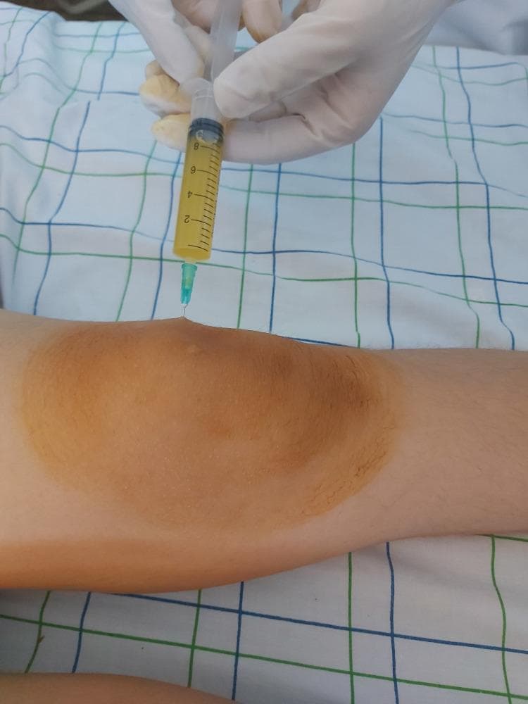 Clinical photograph demonstrating a bedside arthrocentesis (joint aspiration) of the knee. The image shows a gloved medical professional inserting a needle into the suprapatellar region of a significantly swollen knee joint. The knee exhibits a prominent joint effusion and has been prepped with a brown-tinted antiseptic solution (such as povidone-iodine), resulting in local skin discoloration. A transparent syringe attached to the needle contains approximately 3-4 mL of aspirated synovial fluid. The fluid is described as citrine yellow and appears transparent with an inflammatory quality, lacking visible turbidity, blood, or purulence. This procedure is being performed to evaluate for conditions such as septic arthritis or acute rheumatic fever in the context of polyarthritis. The visual highlights the technique for synovial fluid analysis and the physical manifestation of knee joint effusion.