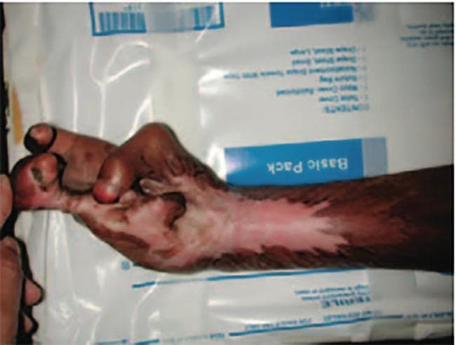 Clinical photograph of a young patient's hand and forearm demonstrating severe post-burn contractures, specifically following an electrical injury. The image shows extensive hypertrophic scarring and tissue fibrosis spanning the forearm and hand. There is a prominent mottled skin appearance with areas of hypopigmentation (leukoderma) centrally along the forearm and palm, surrounded by hyperpigmentation. The hand is fixed in a non-functional, clenched posture characterized by severe flexion contractures of the fingers and adduction of the thumb. These findings indicate a significant loss of range of motion and functional impairment, including inability to perform basic grasping or manipulation. The clinical presentation is characteristic of poorly managed or chronic severe burn wounds, where contracting scar tissue leads to permanent orthopedic and soft tissue deformities. This visual is used to teach the consequences of delayed plastic surgical intervention, such as contracture release and skin grafting, in resource-limited settings.