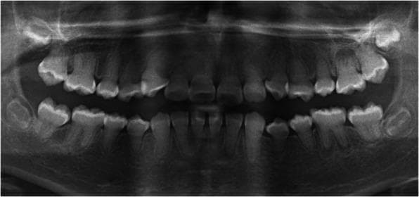 This panoramic dental radiograph (orthopantomogram) of a 12-year-old female demonstrates the classic radiographic features of Dentin Dysplasia Type I (DD-1), also known as radicular dentin dysplasia. The most striking abnormality is the near-total obliteration or significant reduction of pulp chambers and root canals across the entire dentition, appearing as solid radiopaque structures where radiolucent pulp spaces would normally exist. The roots appear atypically shortened, blunted, or 'crescent-shaped' in several segments. Additionally, multiple periapical radiolucencies are visible surrounding the apices of teeth 15, 12, 26, 36, 32, 31, and 46. These lesions are particularly significant as they occur in the absence of dental caries or visible restorations, a pathognomonic finding for DD-1 where abnormal dentin structure leads to spontaneous pulpal necrosis and apical periodontitis. The image serves as a key diagnostic reference for identifying hereditary dentin defects and differentiating them from common inflammatory pathologies.
